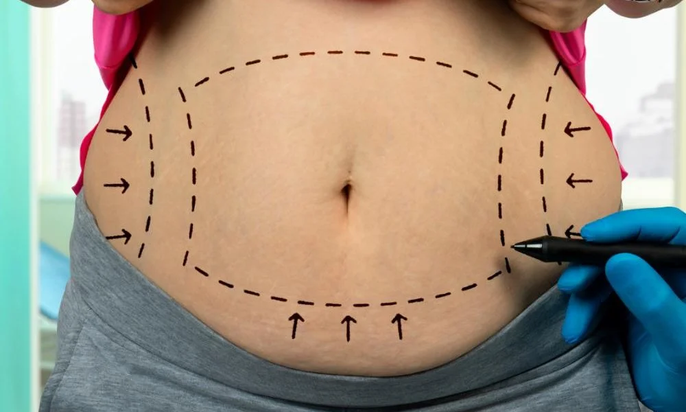 Liposuction: What to Expect Before, During, and After the Procedure