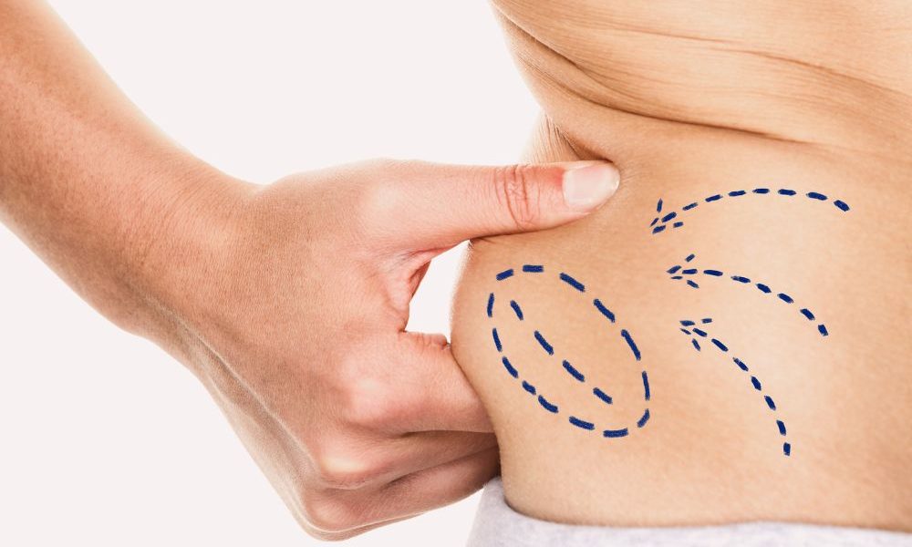 How Liposuction Can Complement Other Cosmetic Procedures