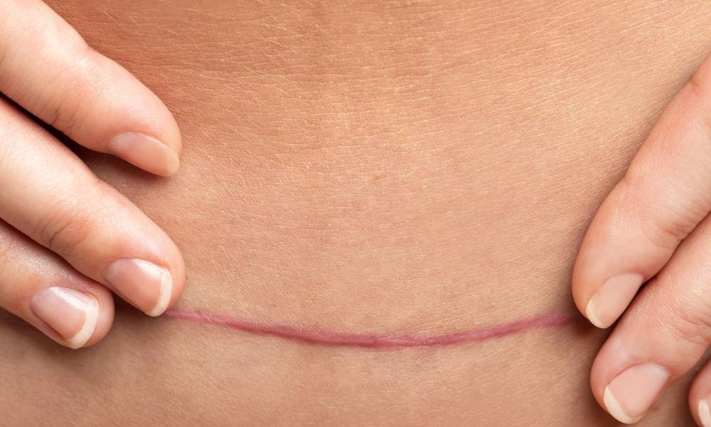 Post-Surgery Scar Care: Minimize Scarring and Optimize Your Results