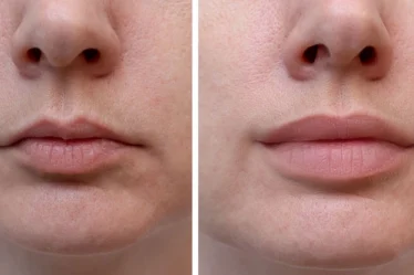 Complete Guide to Lip Fillers Natural to Dramatic Looks Explained