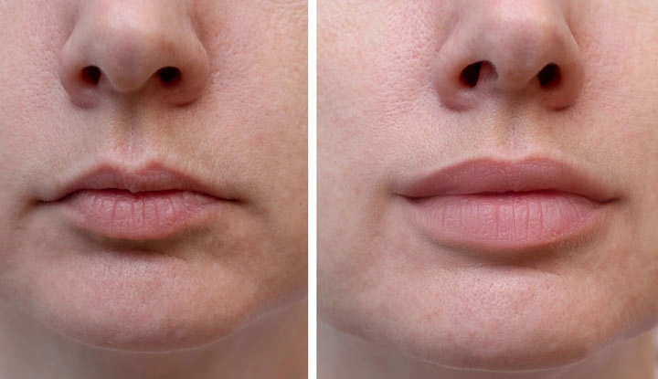 Complete Guide to Lip Fillers Natural to Dramatic Looks Explained